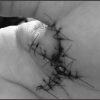 figure-2-injury-stitches
